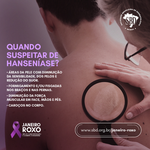Hanseníase tem cura e o tratamento é gratuito e ofertado pelo SUS
